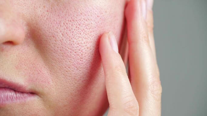 How does age factor into enlarged pores?